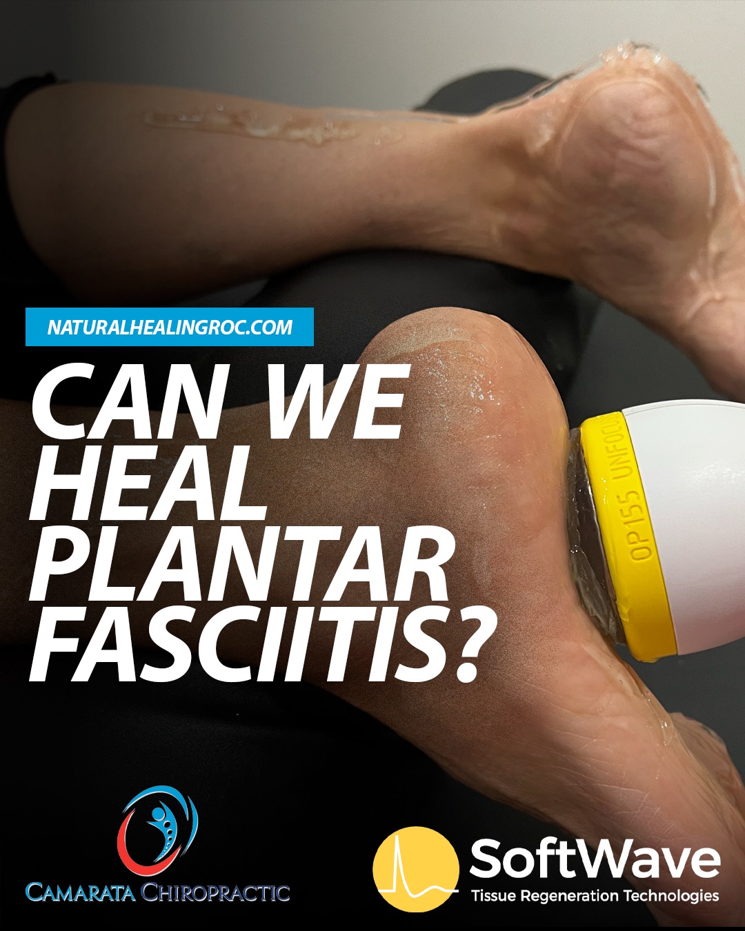 Healing Plantar Fasciitis with SoftWave Therapy at Camarata Chiropractic & Wellness