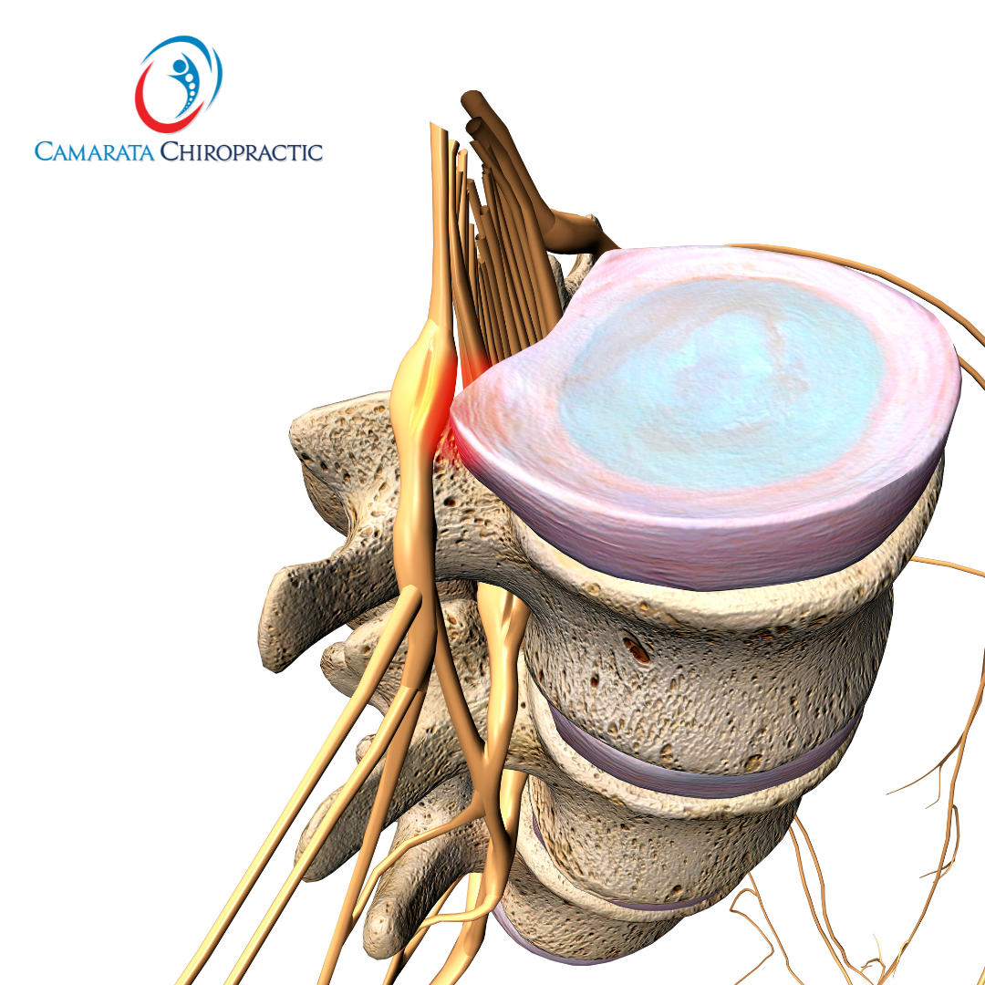 Lumbar Spine Herniated Discs and SoftWave Therapy: A Non-Surgical Option in Rochester, NY