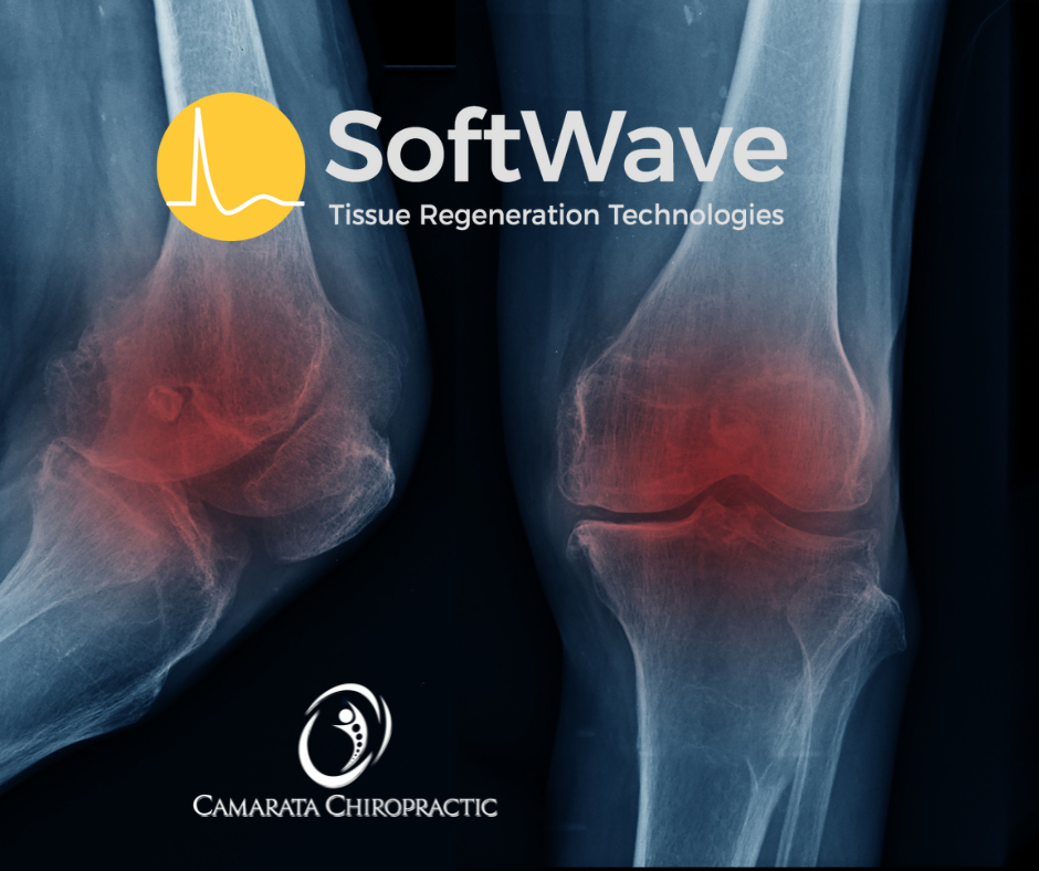 Transforming Knee Arthritis Treatment: SoftWave Therapy's Breakthrough at Camarata Chiropractic & Wellness