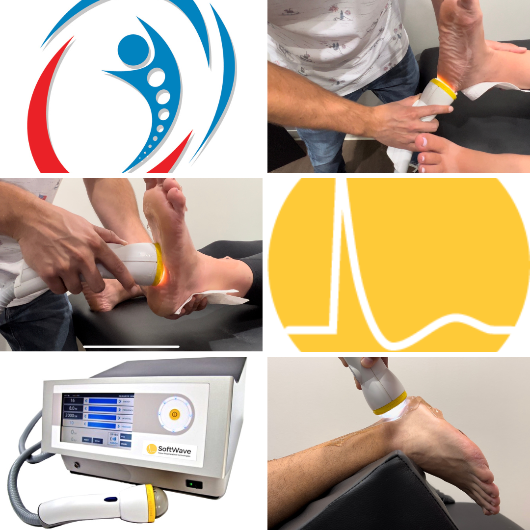 SoftWave Therapy: A Beacon of Relief for Plantar Fasciitis Sufferers